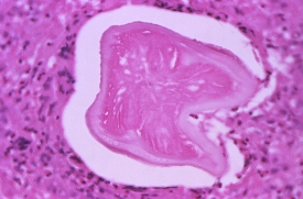 tissue specimen showing roundworm