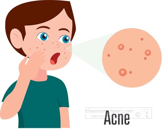 boy with acne on his face clipart