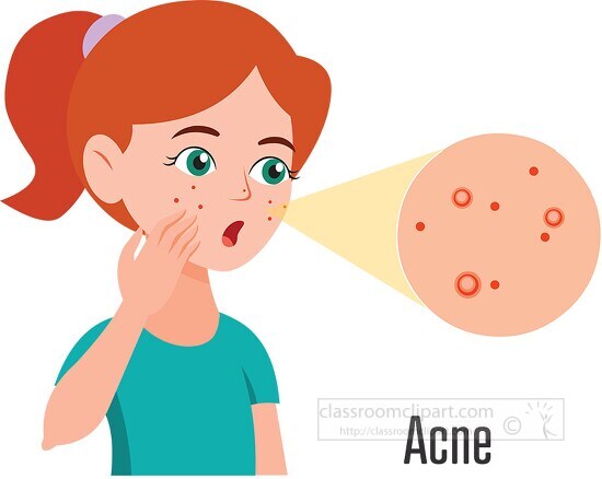 girl with acne on her face clipart