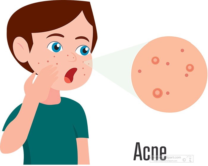 boy-with-acne-on-his-face-clipart.jpg