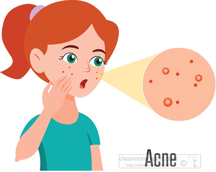 girl-with-acne-on-her-face-clipart.jpg