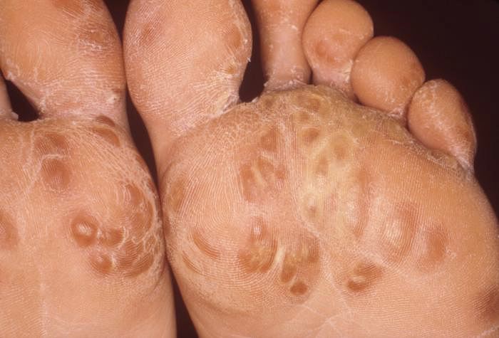 foot_disease.jpg